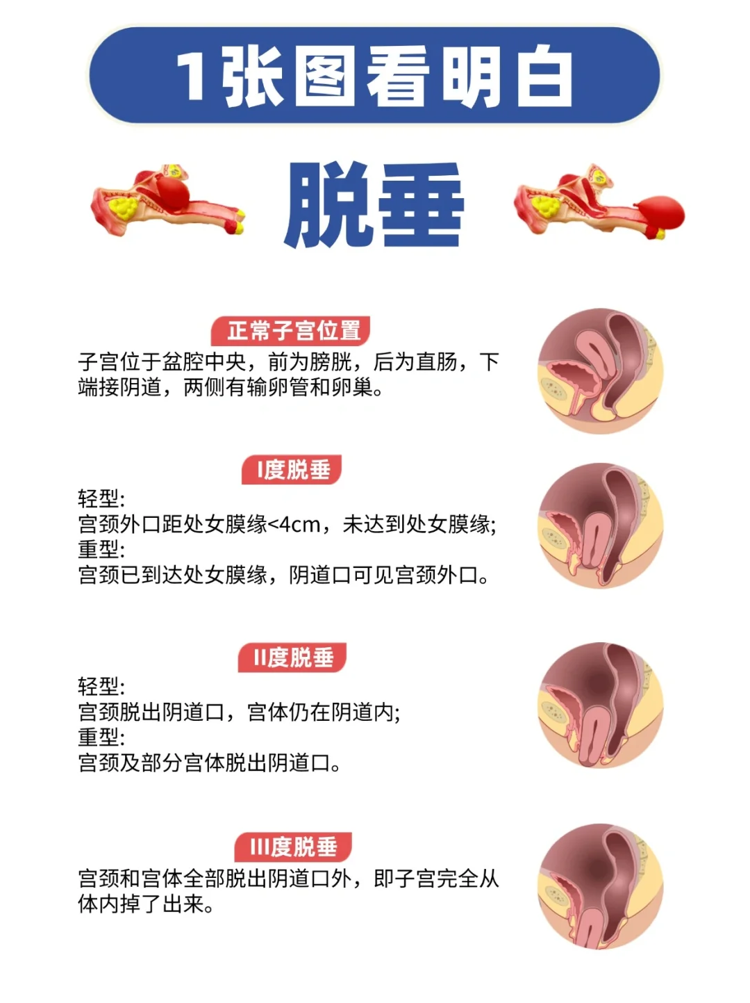 盆底脱垂的常见症状与原因解析，了解辅助生殖的有效应对